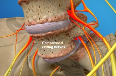 compressed exiting nerves