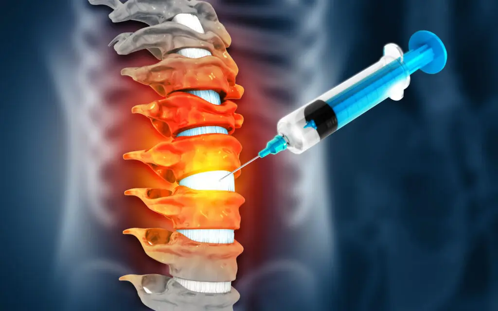 A digital illustration of a human spine with several vertebrae highlighted in red and orange, suggesting inflammation, while a syringe is positioned near the inflamed area, indicating an injection treatment.