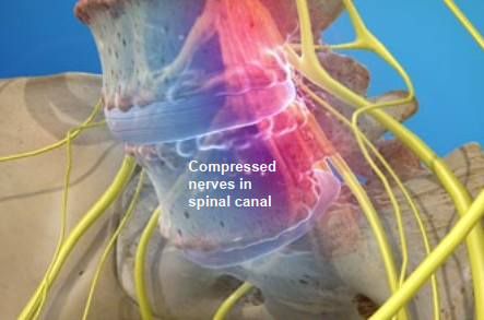 Medical illustration of a spinal column showing compressed nerves in the spinal canal, highlighted in red, with yellow nerve pathways around the vertebrae and a blue background. Text reads: Compressed nerves in spinal canal.