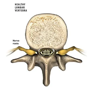 Illustration of a healthy lumbar vertebra, shown from above. The image highlights the bone structure and the yellow nerve roots extending from both sides of the spinal cord.