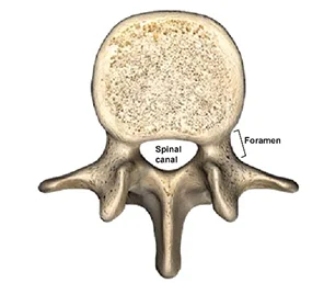A labeled diagram of a vertebra showing the spinal canal in the center and the foramen opening to the right side. The bone structure includes protruding processes.
