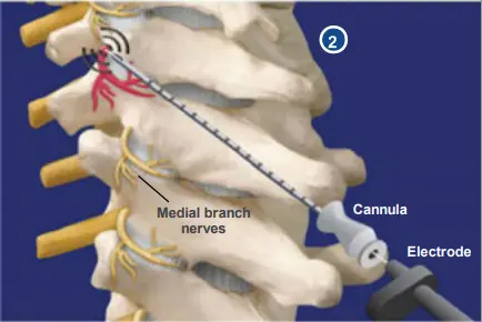 Medical illustration of a spine showing a cannula and electrode targeting medial branch nerves for a procedure, with nerves highlighted in red and yellow branching from the vertebrae.