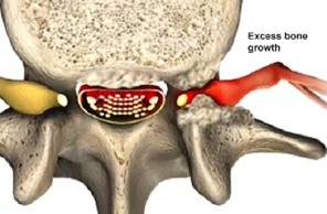 Medical illustration of a spinal vertebra with nerves, showing excess bone growth compressing a nerve on the right side. Labels indicate location of bone growth and affected nerve.