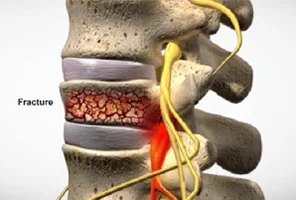 A medical illustration of a spinal column with a visible vertebral fracture labeled, showing compressed bone, surrounding discs, and highlighted nerves to indicate inflammation or pain.