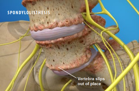 Vertebra slips out of place